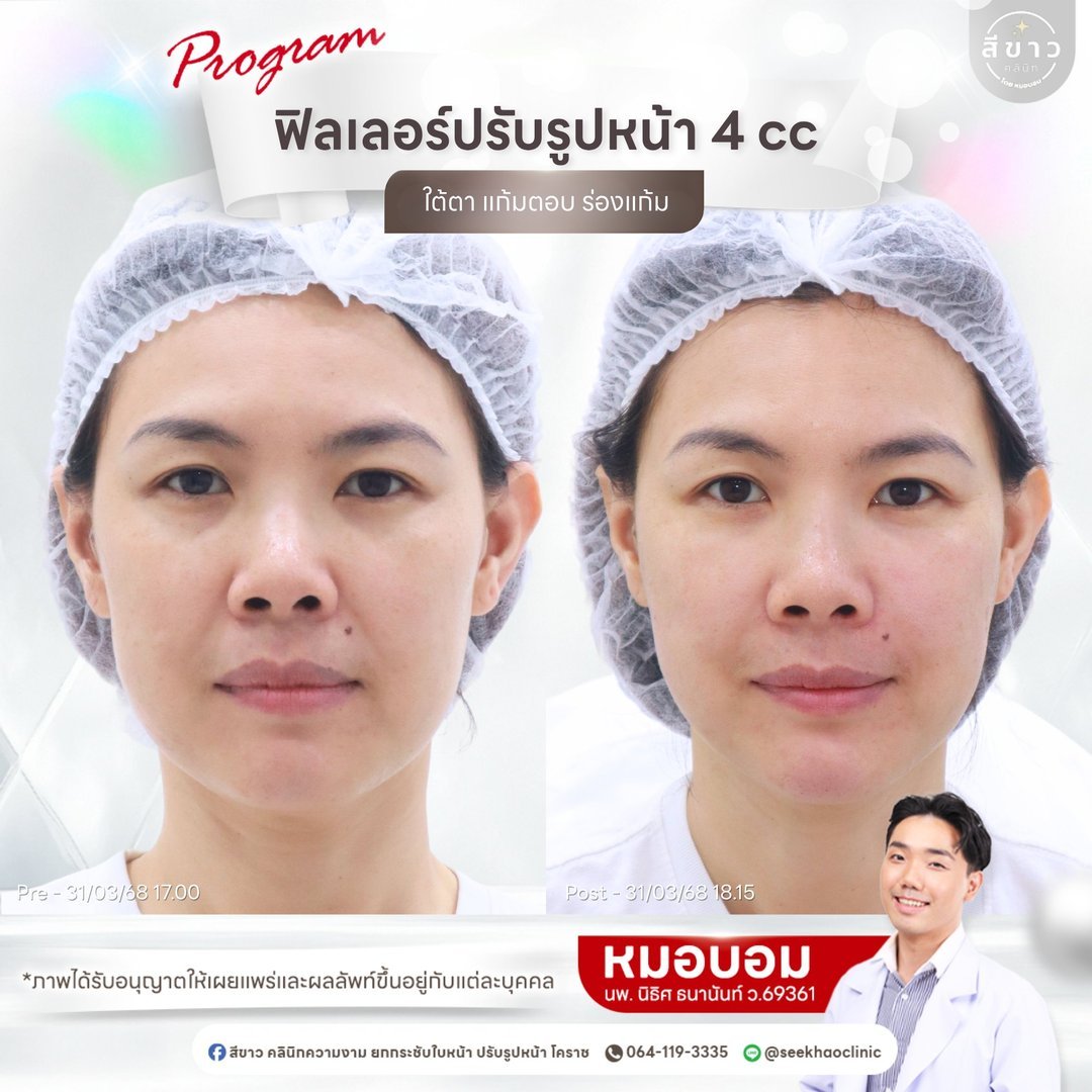 Filler ปรับรูปหน้า 4 cc (ใต้ตา แก้มตอบ ร่องแก้ม)