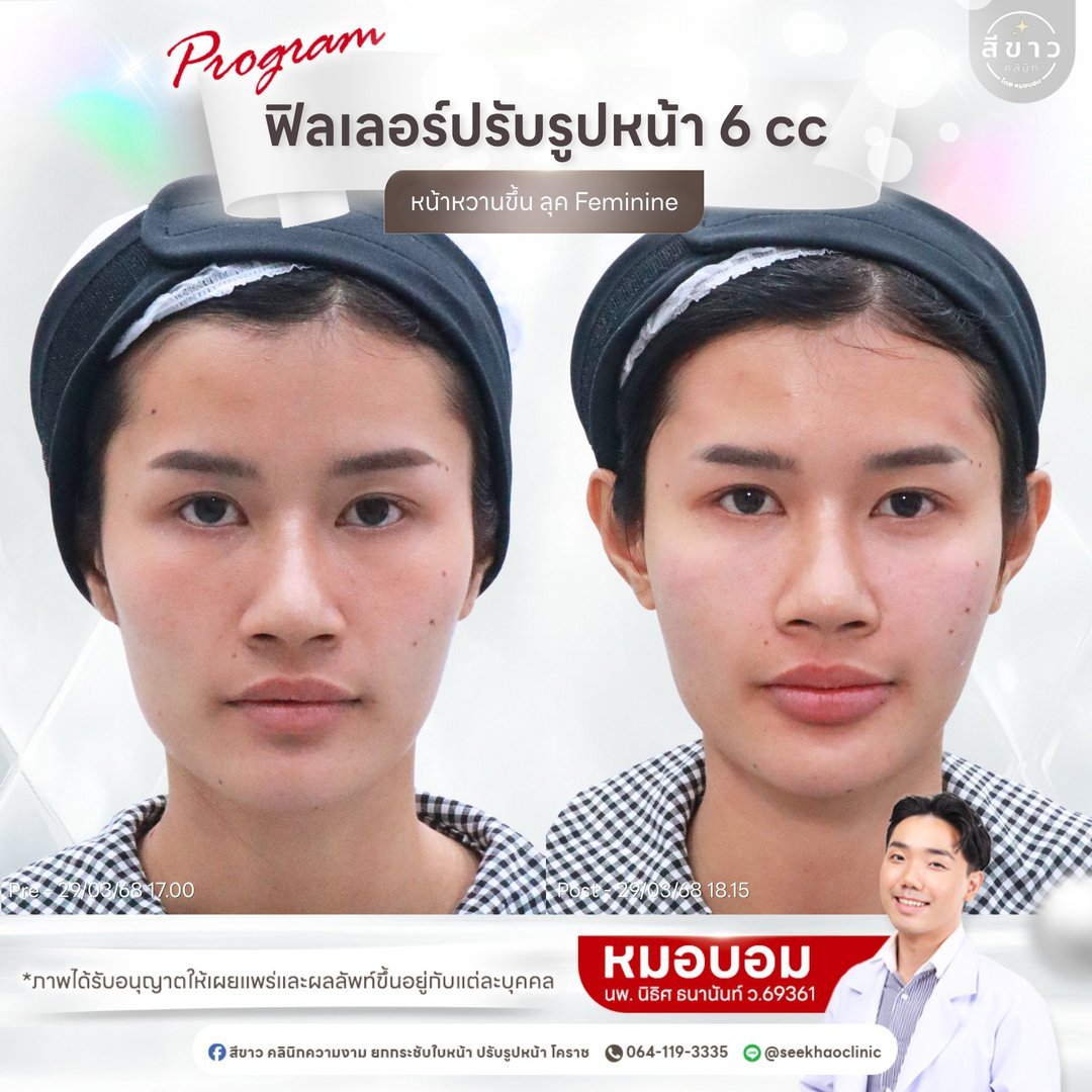 Filler ปรับรูปหน้า 6 cc (หน้าหวานขึ้น ลุค Feminine)