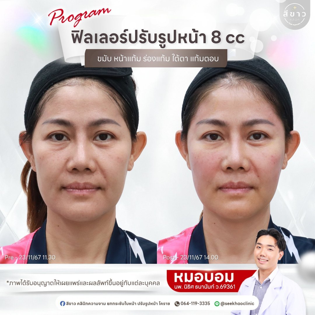 Filler ปรับรูปหน้า 8 cc (ขมับ หน้าแก้ม ร่องแก้ม ใต้ตา แก้มตอบ)