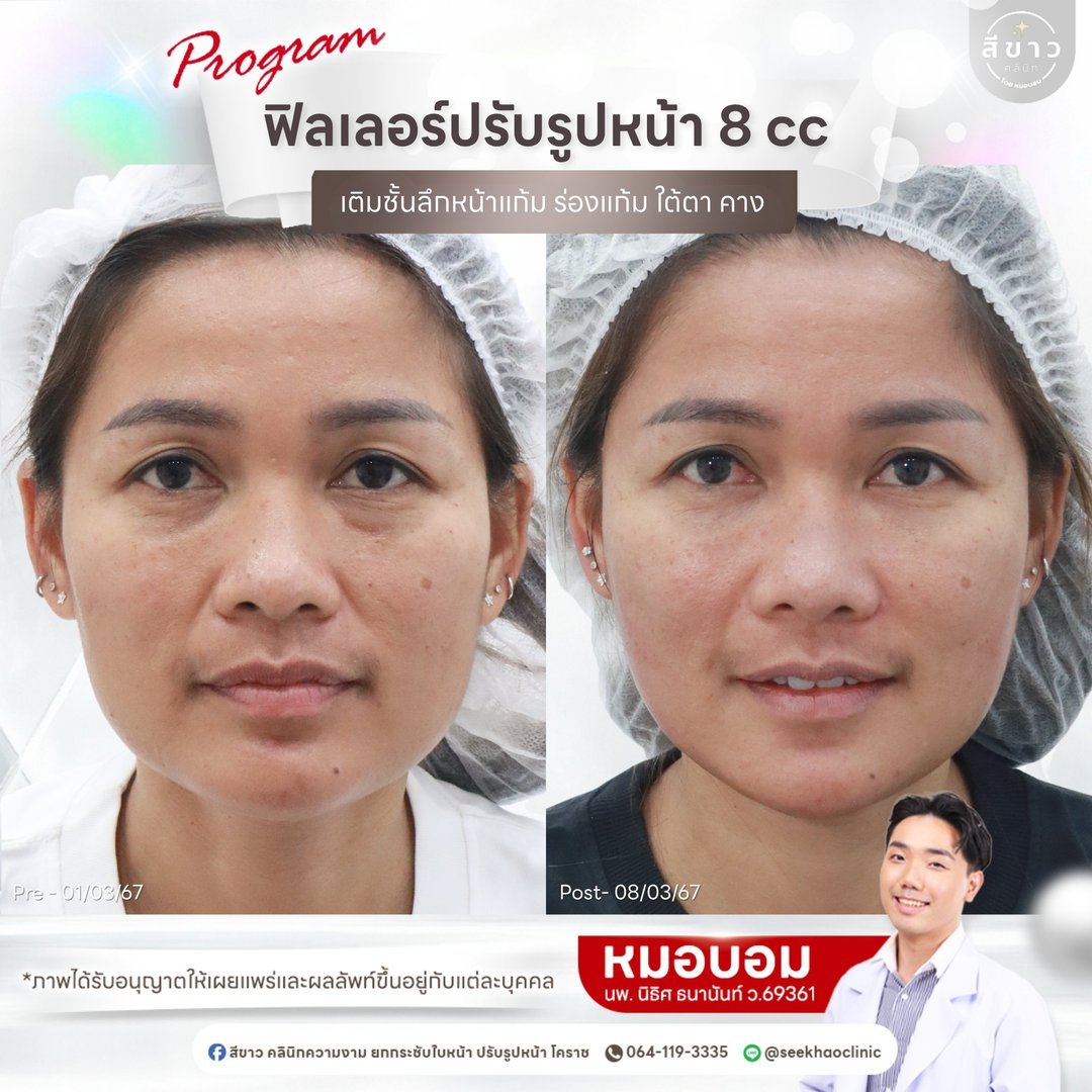 Filler ปรับรูปหน้า 8 cc (หน้าแก้ม ร่องแก้ม ใต้ตา คาง)