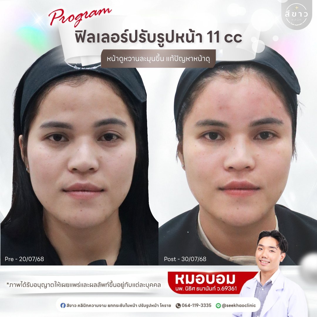 Filler ปรับรูปหน้า 11 cc