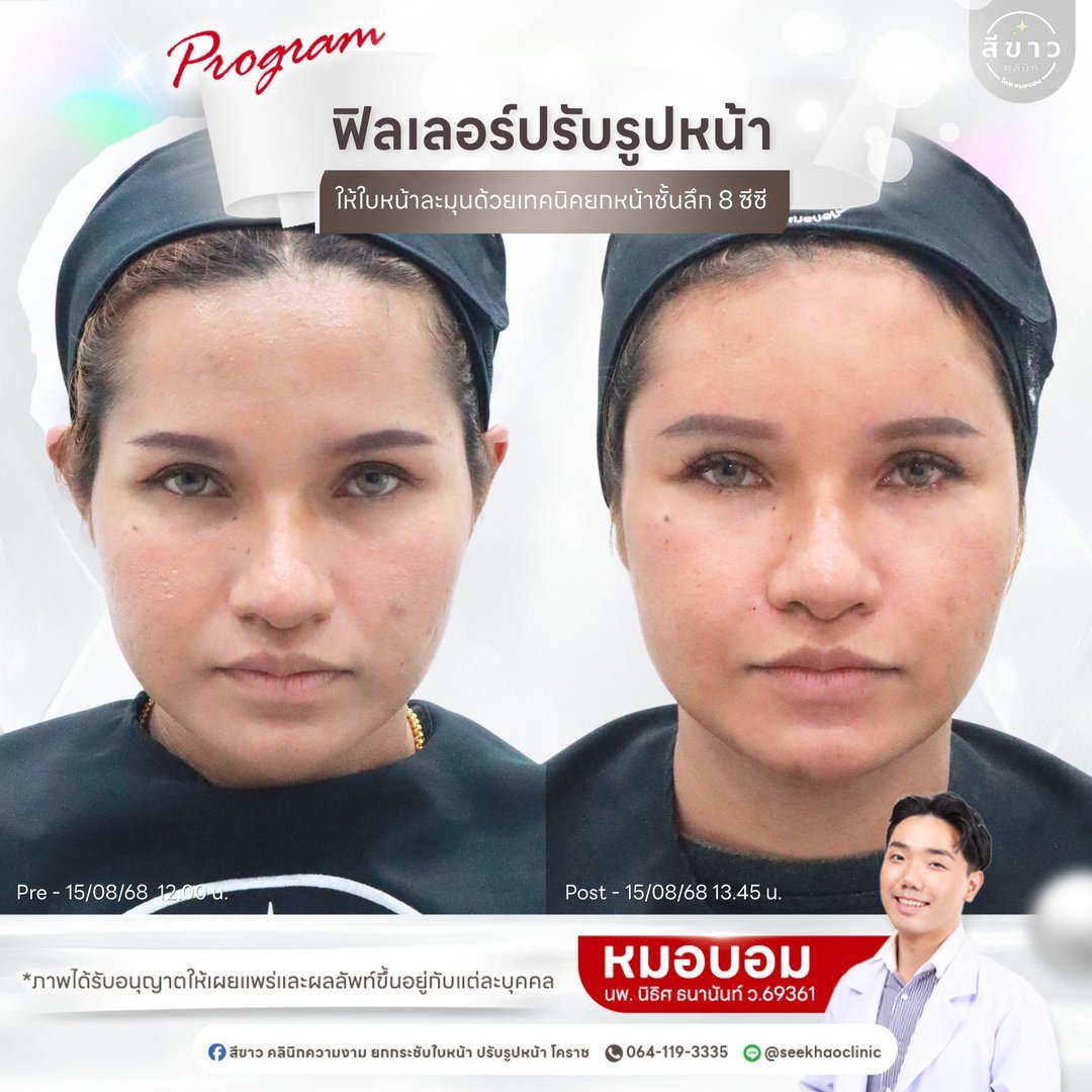 Filler ปรับรูปหน้า ยกหน้าชั้นลึก 8 ซีซี