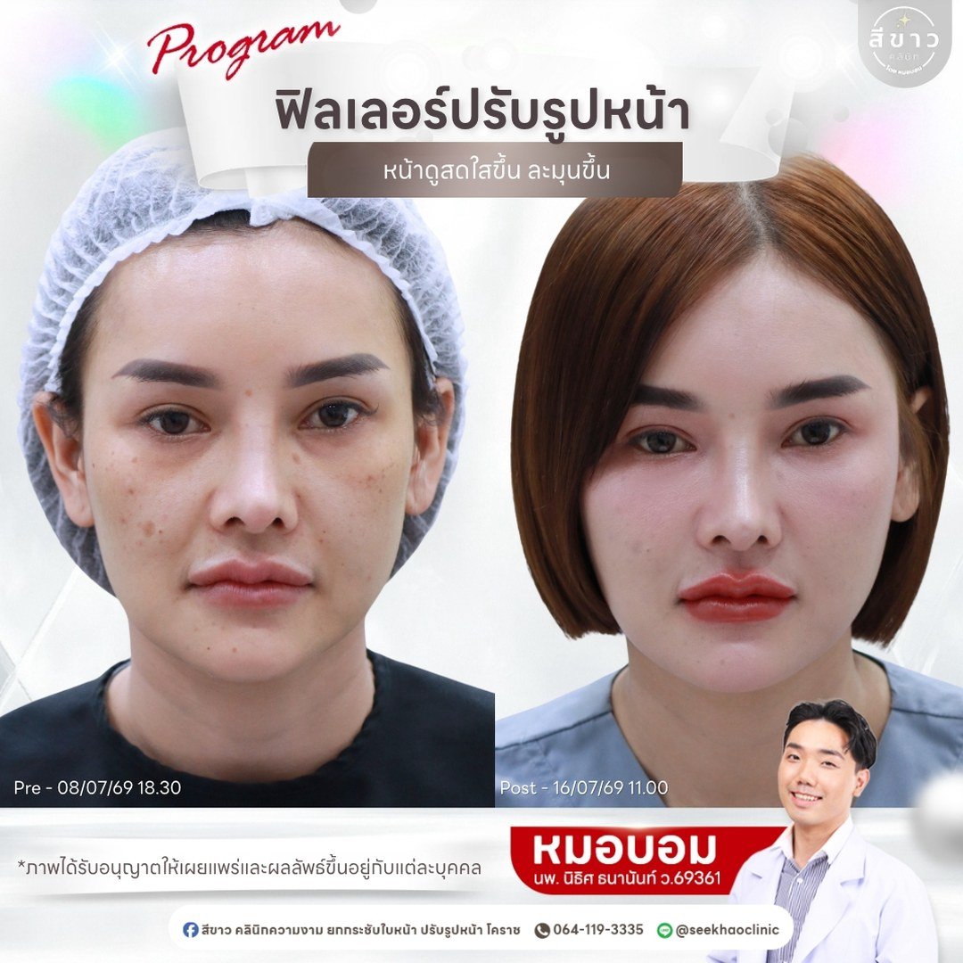 ฟิลเลอร์ปรับรูปหน้า