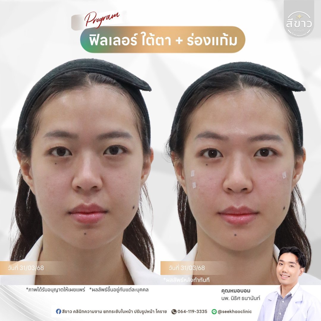 Filler ใต้ตา + ร่องแก้ม