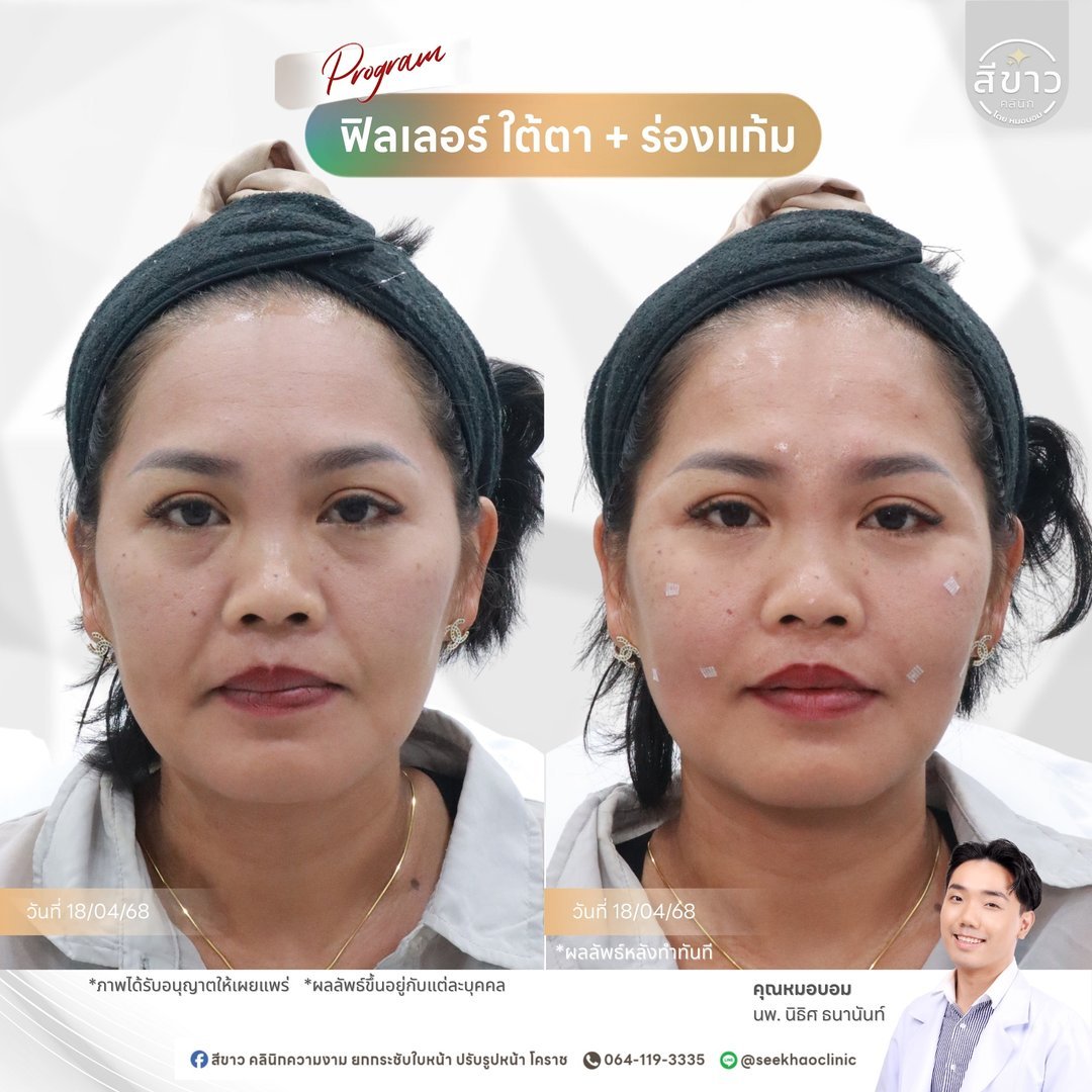 Filler ใต้ตา + ร่องแก้ม