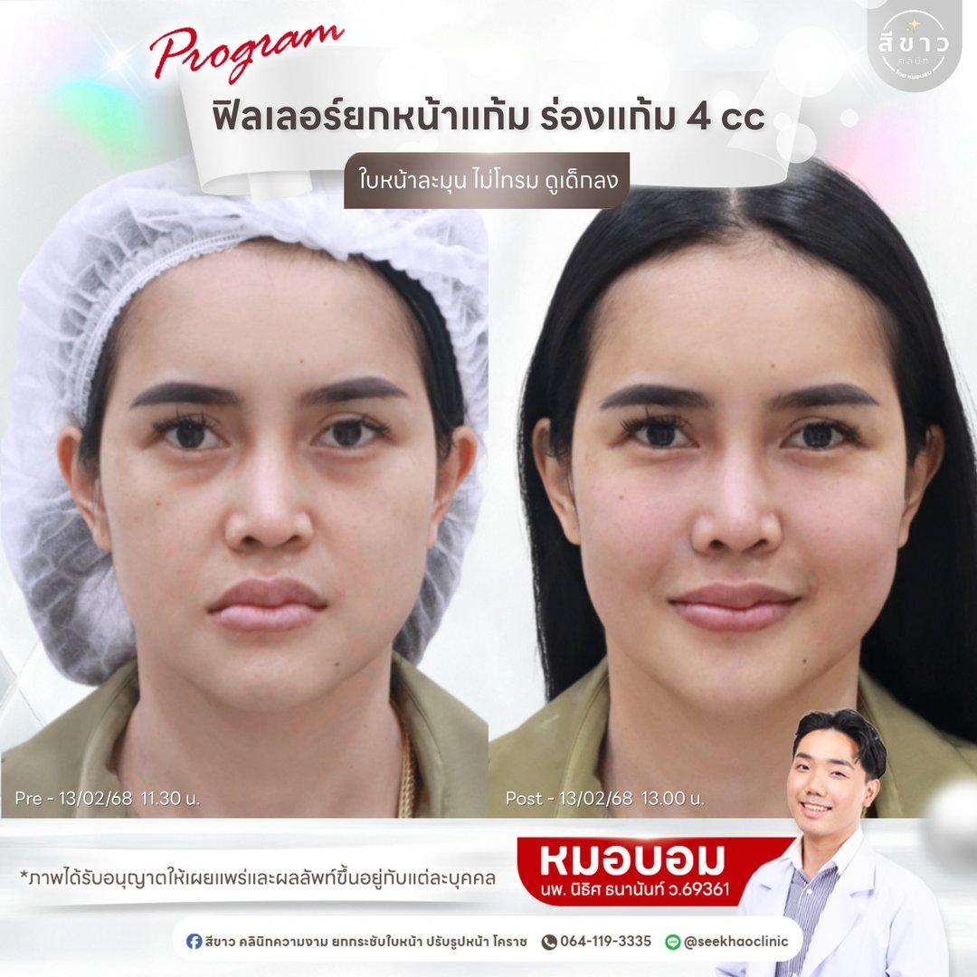 Filler ยกหน้าแก้ม ร่องแก้ม 4 cc