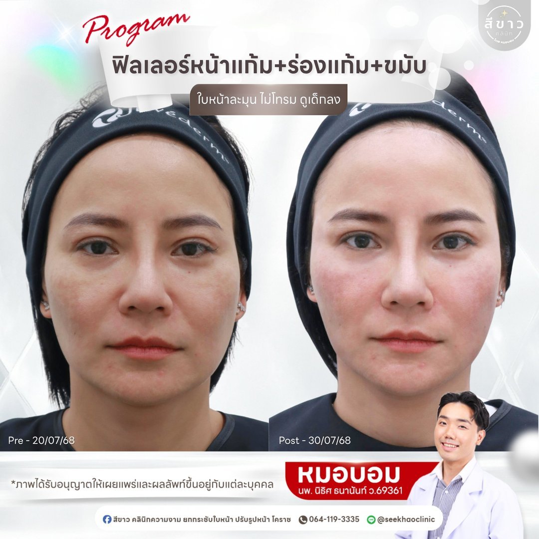 Filler หน้าแก้ม + ร่องแก้ม + ขมับ