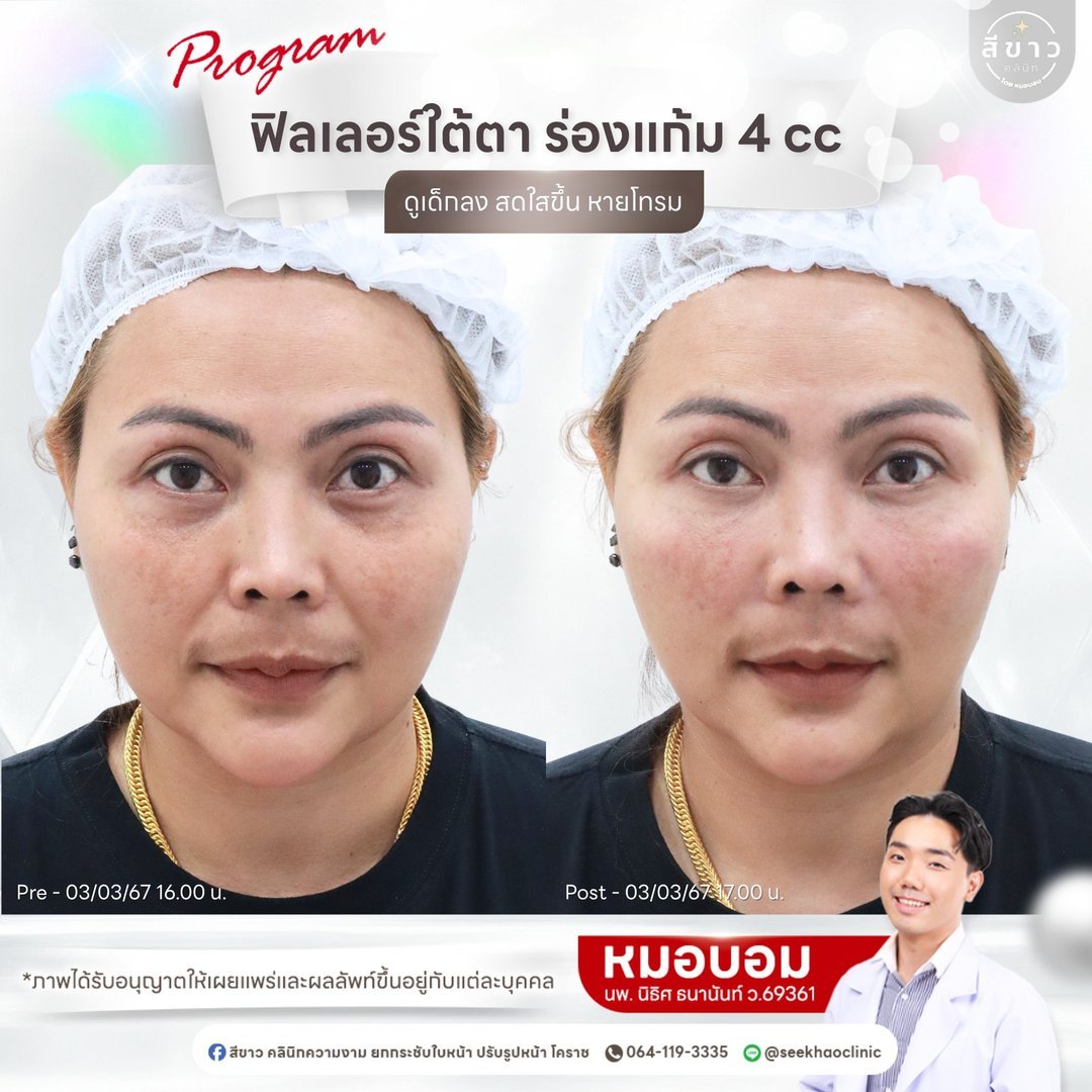 Filler ใต้ตา ร่องแก้ม 4 cc