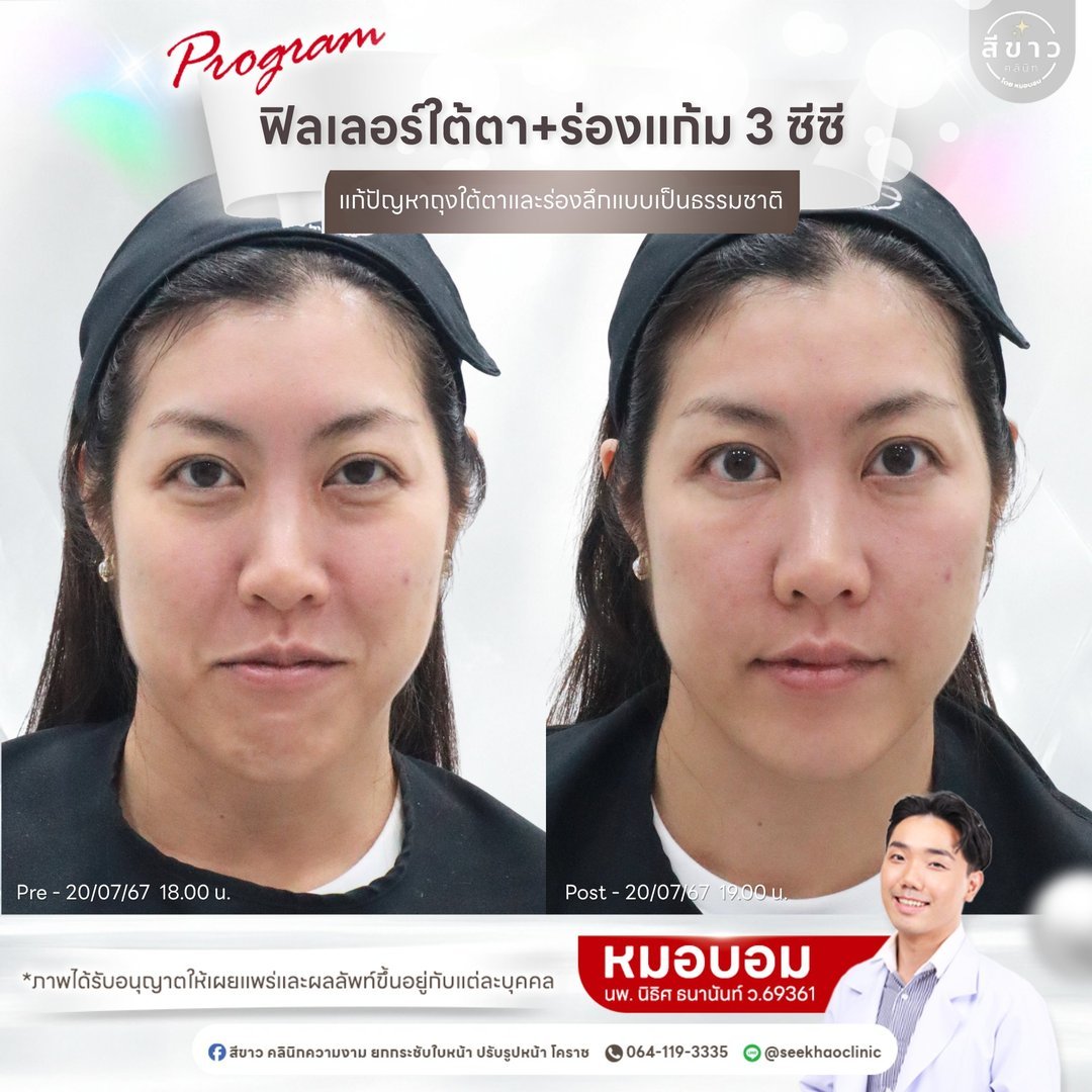 Filler ใต้ตา + ร่องแก้ม 3 cc