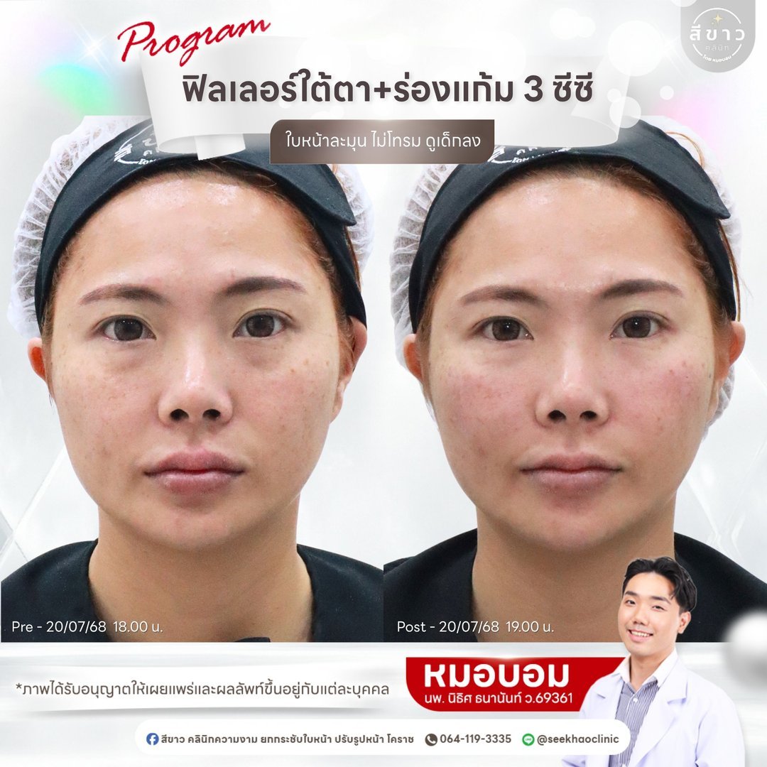 Filler ใต้ตา + ร่องแก้ม 3 cc