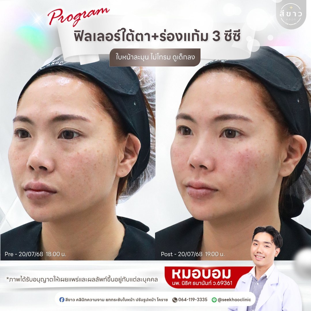 Filler ใต้ตา + ร่องแก้ม 3 cc