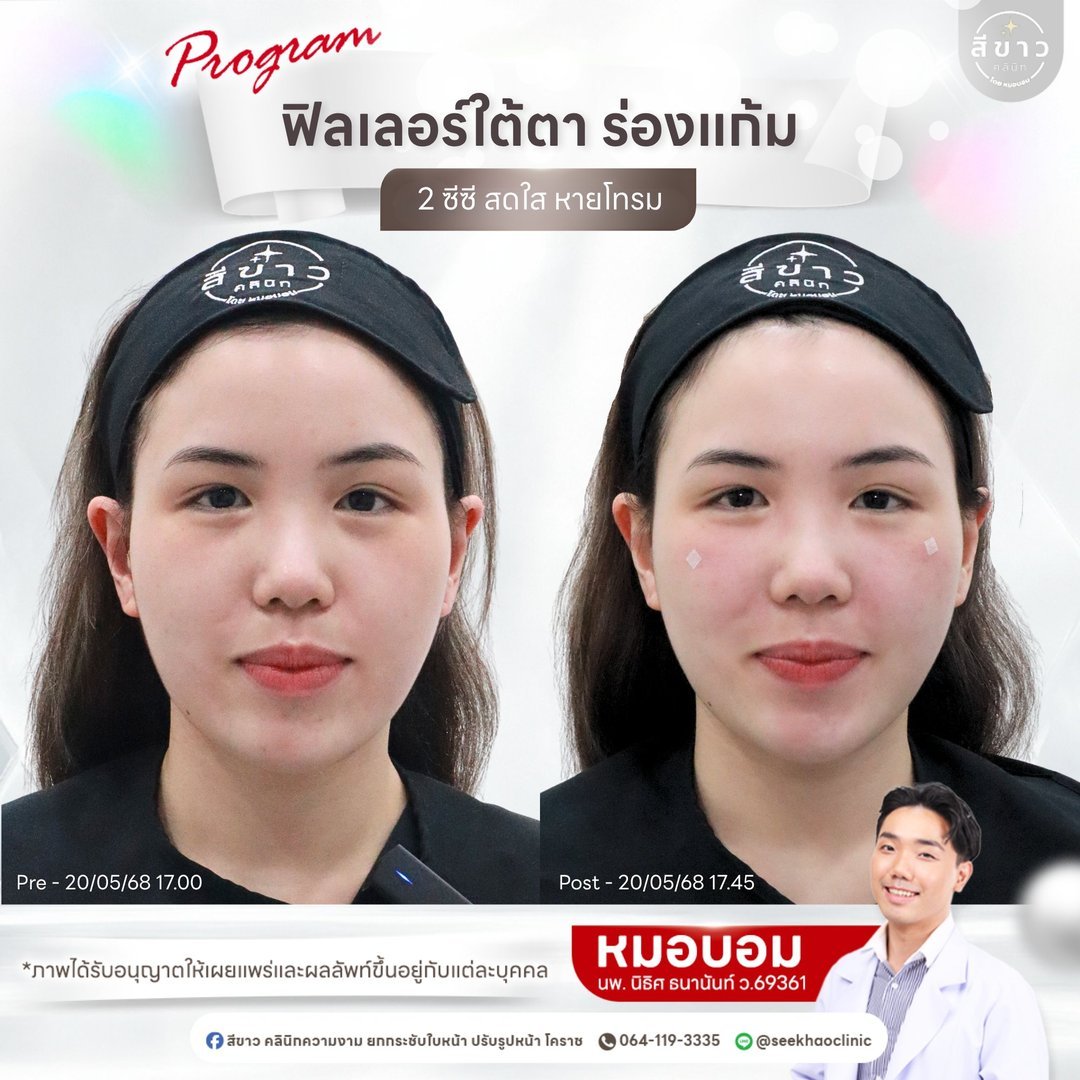 Filler ใต้ตา ร่องแก้ม 2 ซีซี