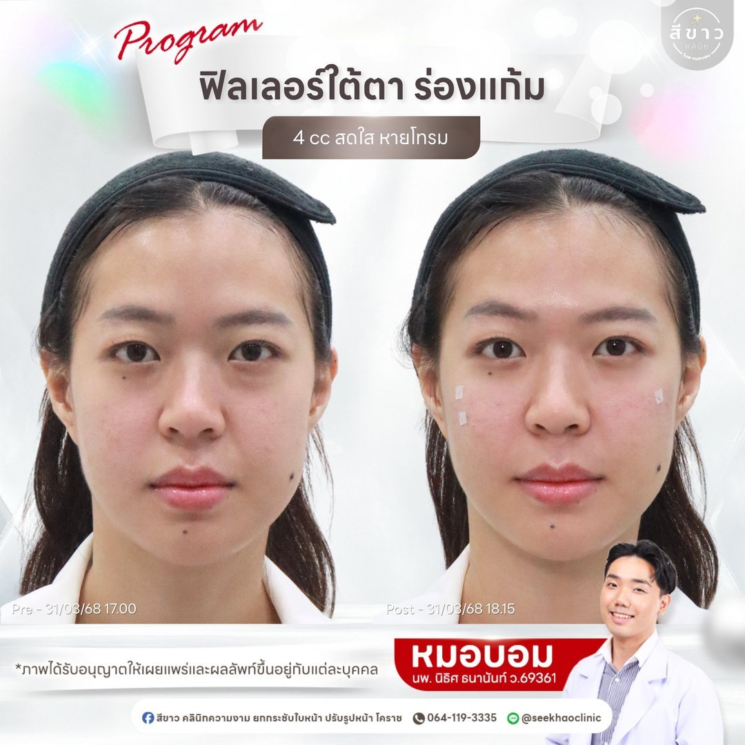 Filler ใต้ตา ร่องแก้ม 4 cc