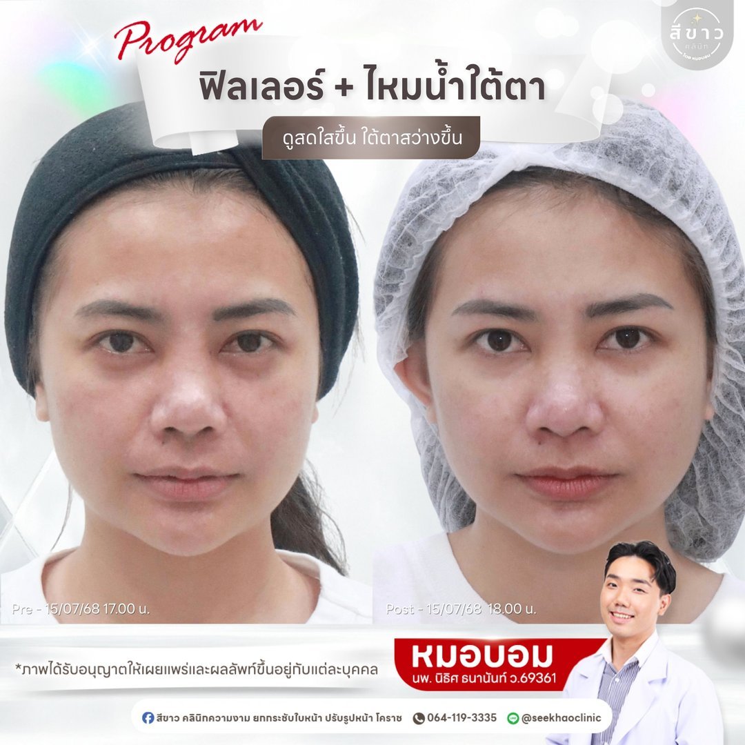 Filler + ไหมน้ำใต้ตา