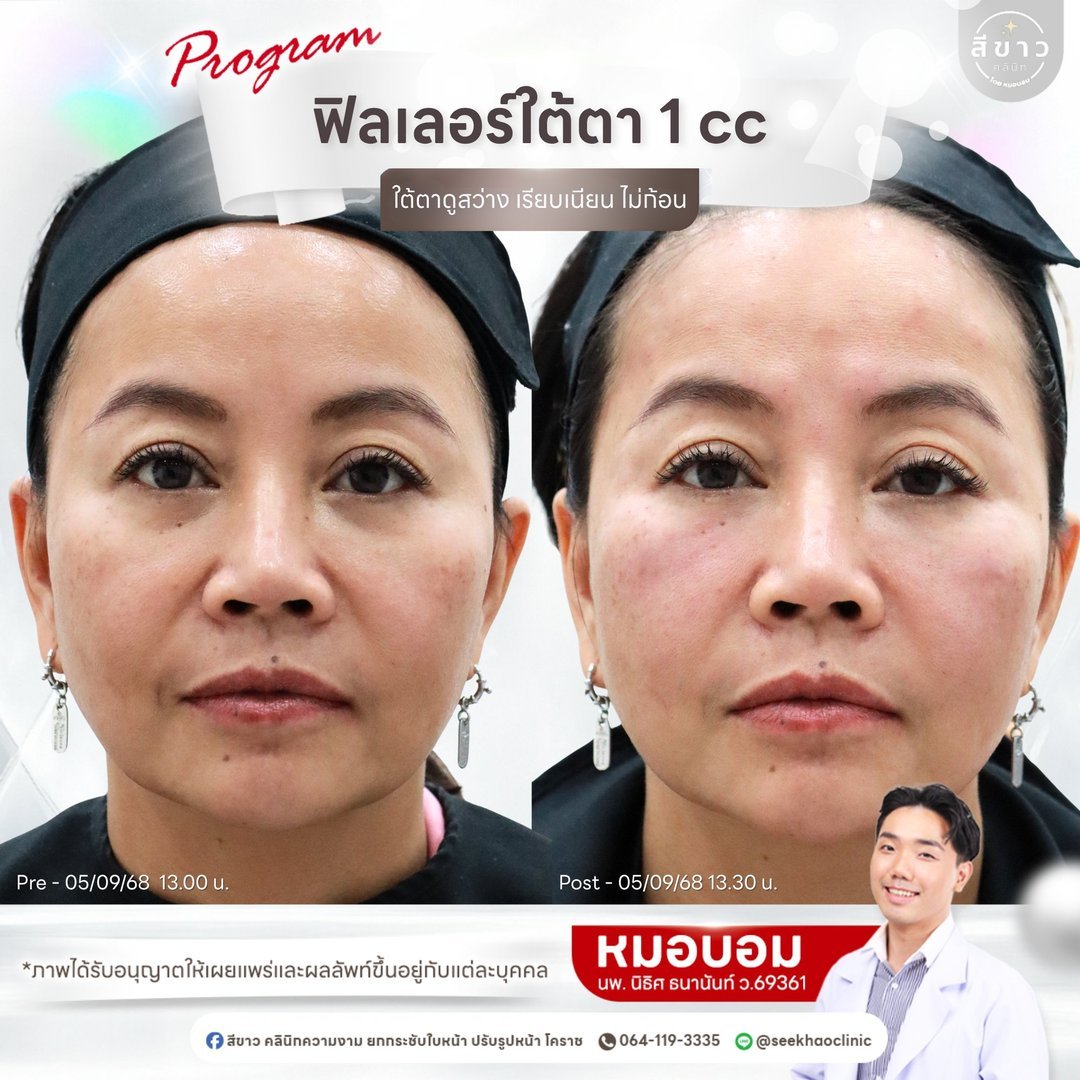 Filler ใต้ตา 1 cc