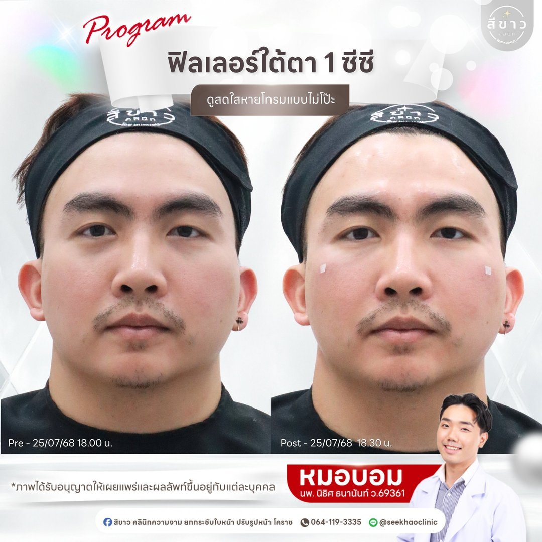 Filler ใต้ตา 1 ซีซี
