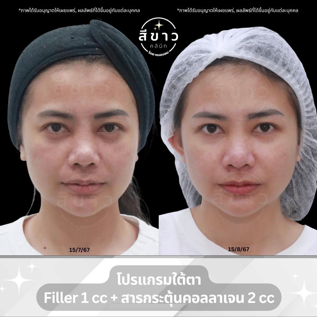 โปรแกรมใต้ตา Filler 1cc + สารกระตุ้นคอลลาเจน 2cc