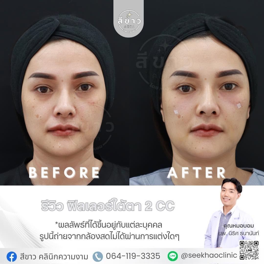 รีวิว ฟิลเลอร์ใต้ตา 2 CC
