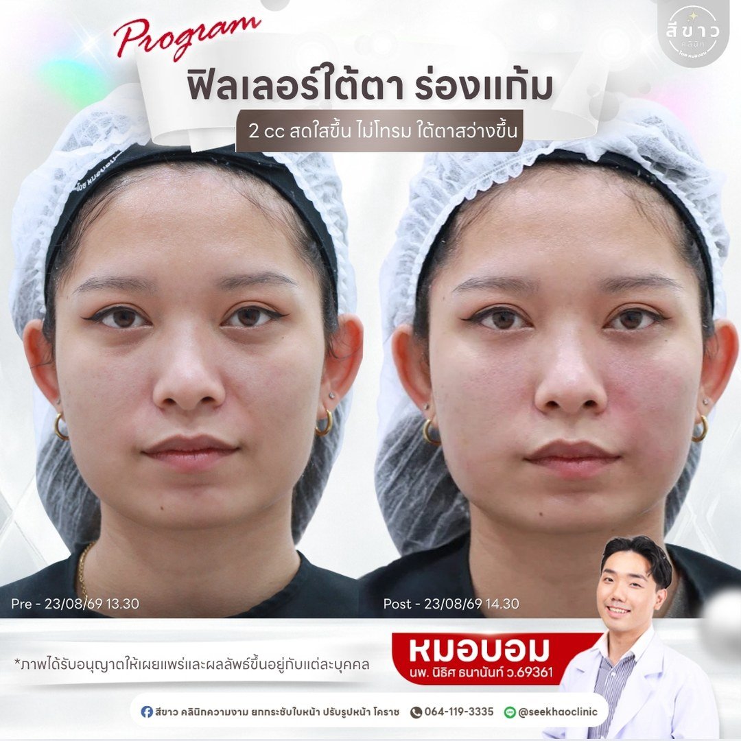 ฟิลเลอร์ใต้ตา ร่องแก้ม 2 cc