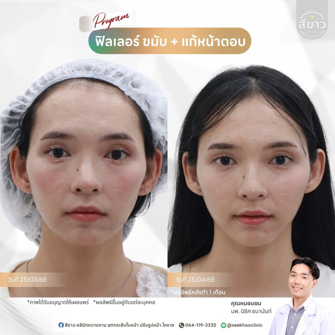 Filler แก้มตอบ (ขมับ + แก้หน้าตอบ)