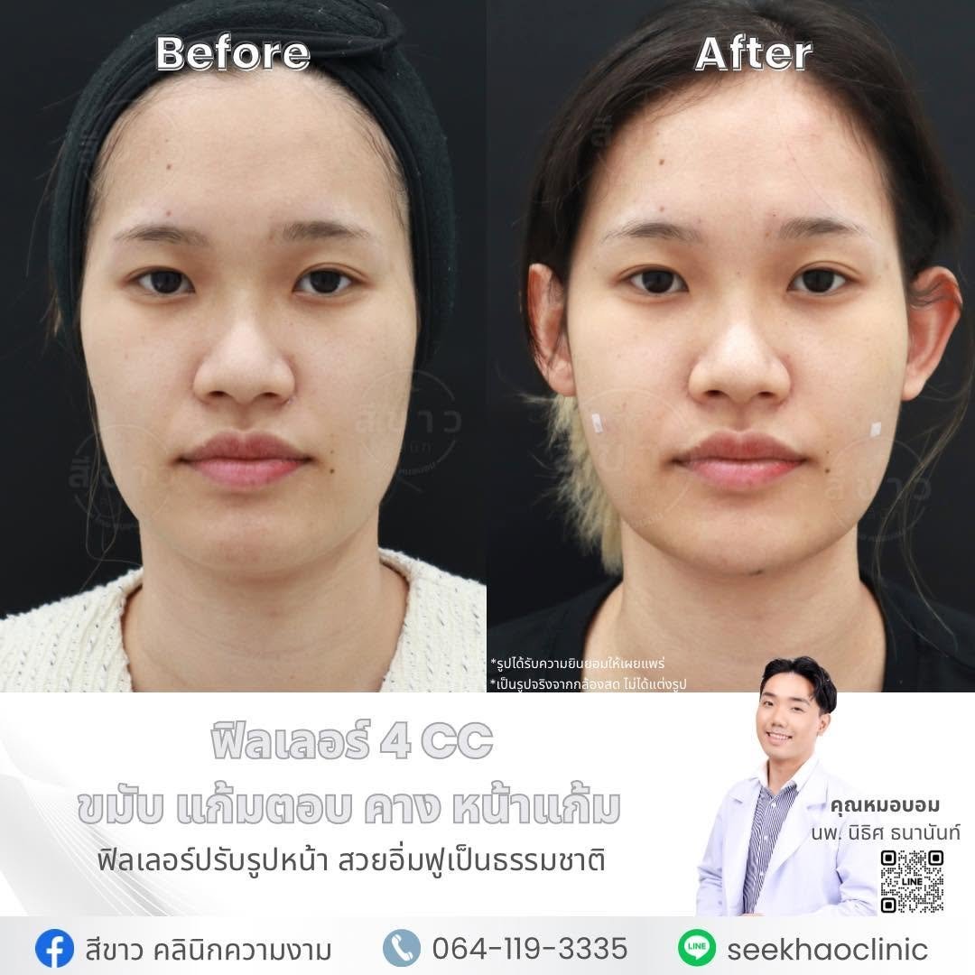 Filler 4 CC ขมับ แก้มตอบ คาง หน้าแก้ม