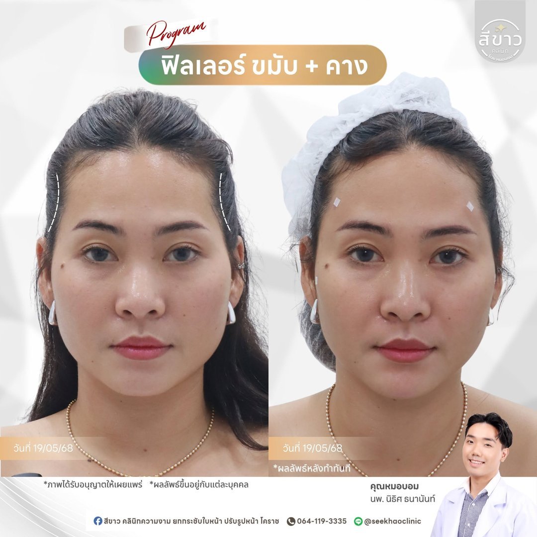 Filler ขมับ + คาง