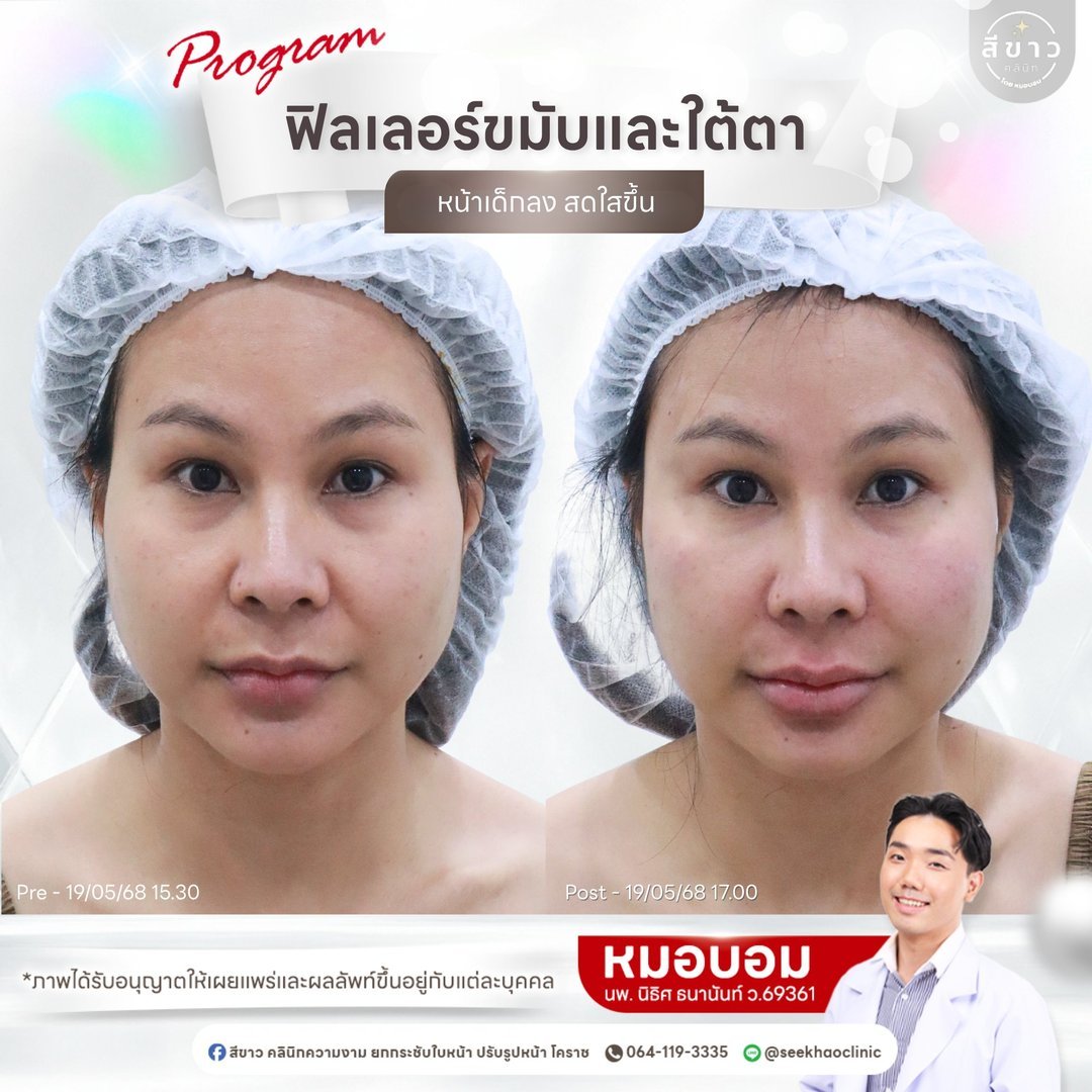 Filler ขมับ และ ใต้ตา