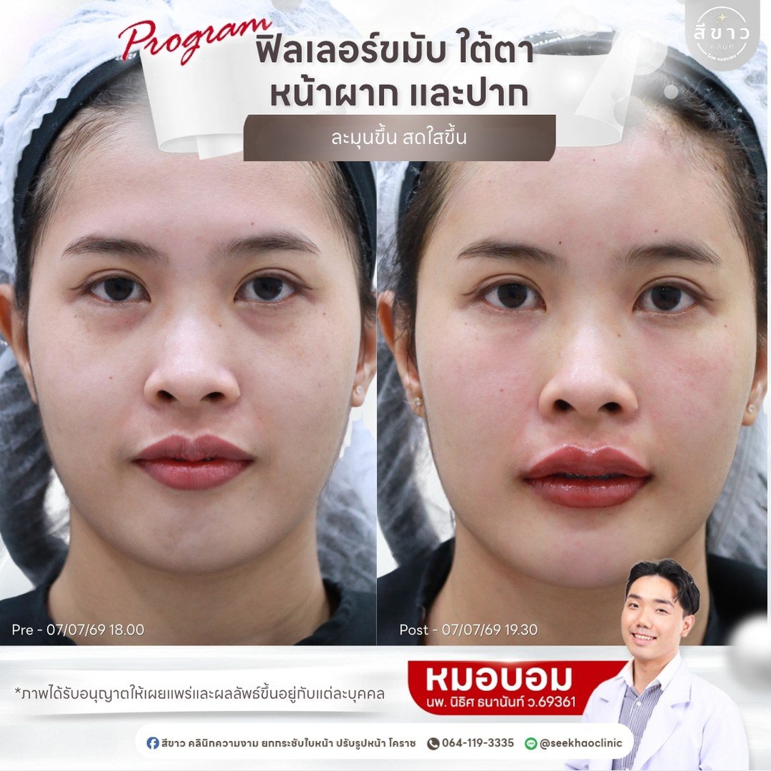 ฟิลเลอร์ขมับ ใต้ตา หน้าผาก และปาก