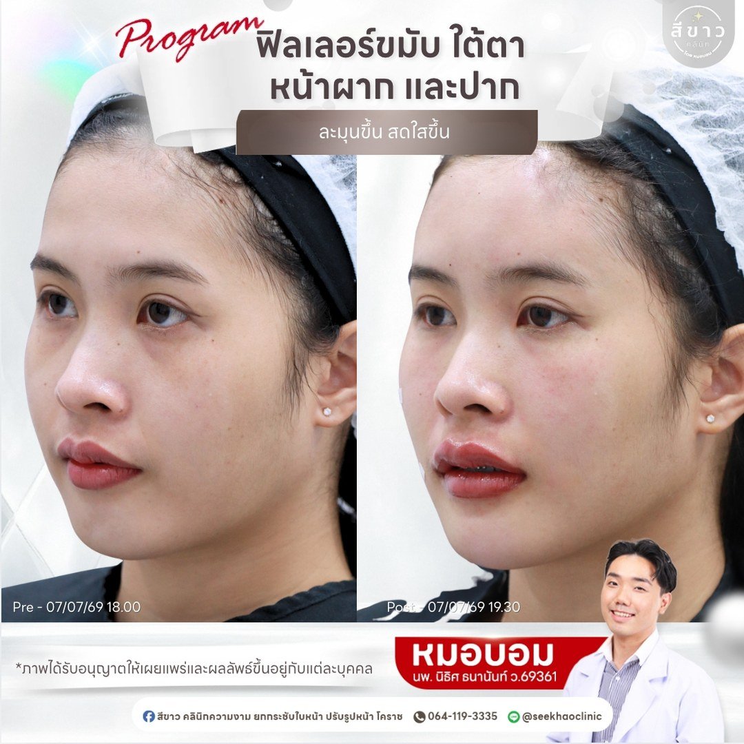 ฟิลเลอร์ขมับ ใต้ตา หน้าผาก และปาก