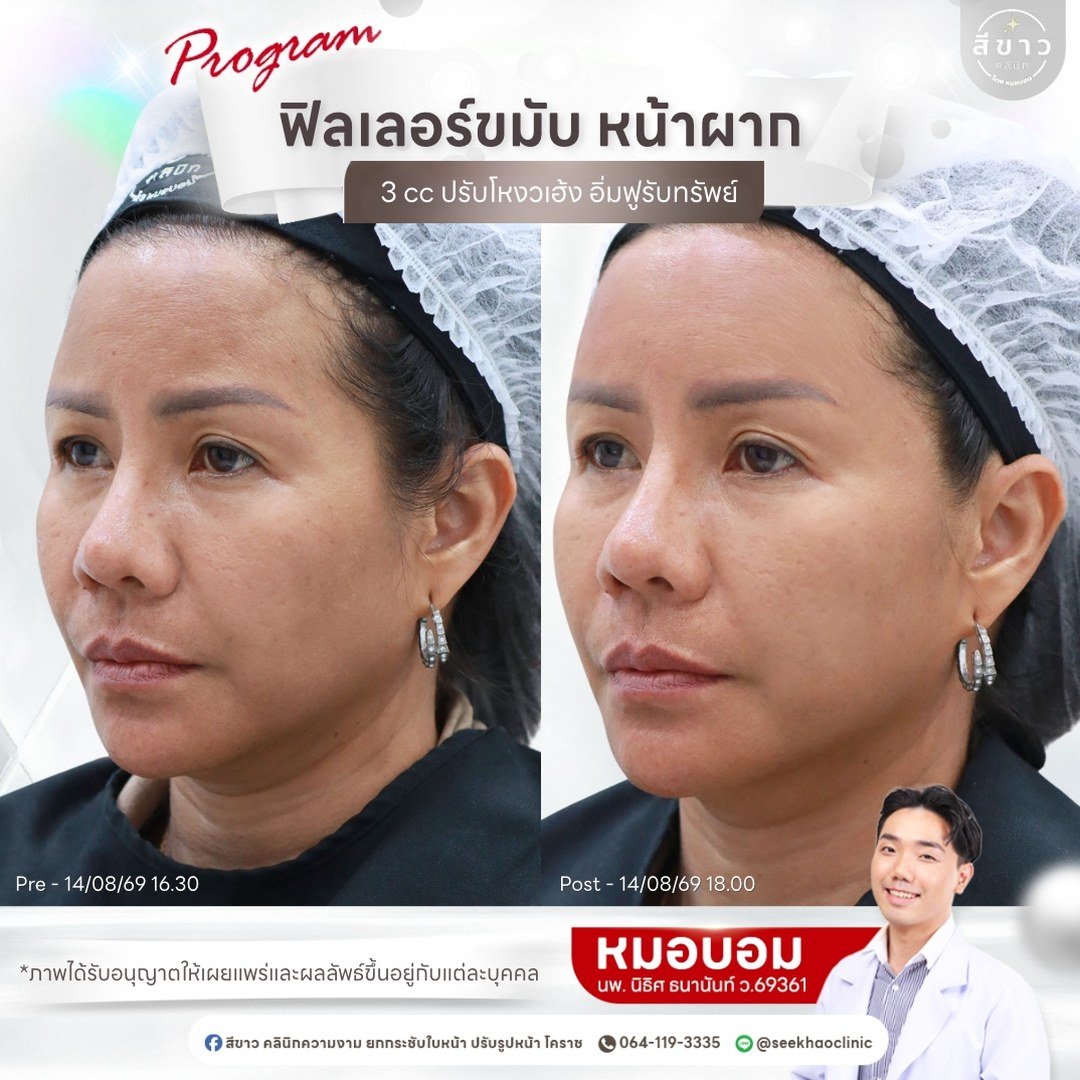 ฟิลเลอร์ขมับ หน้าผาก 3 cc