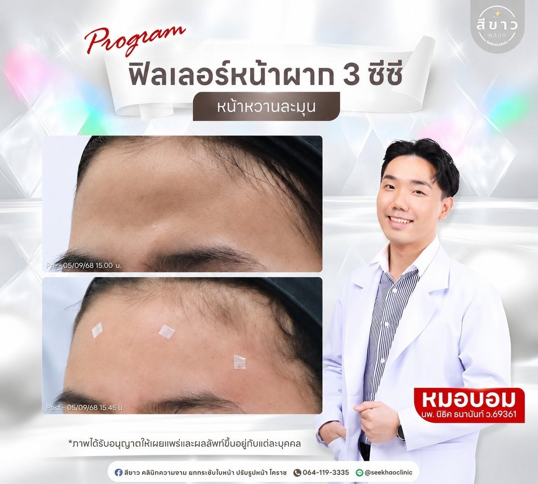 ฟิลเลอร์หน้าผาก 3 ซีซี หน้าหวานละมุน