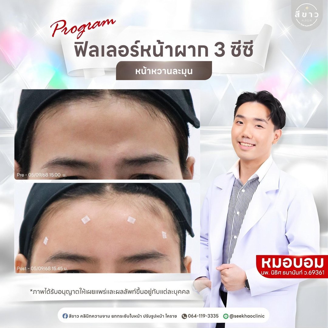 ฟิลเลอร์หน้าผาก 3 ซีซี หน้าหวานละมุน