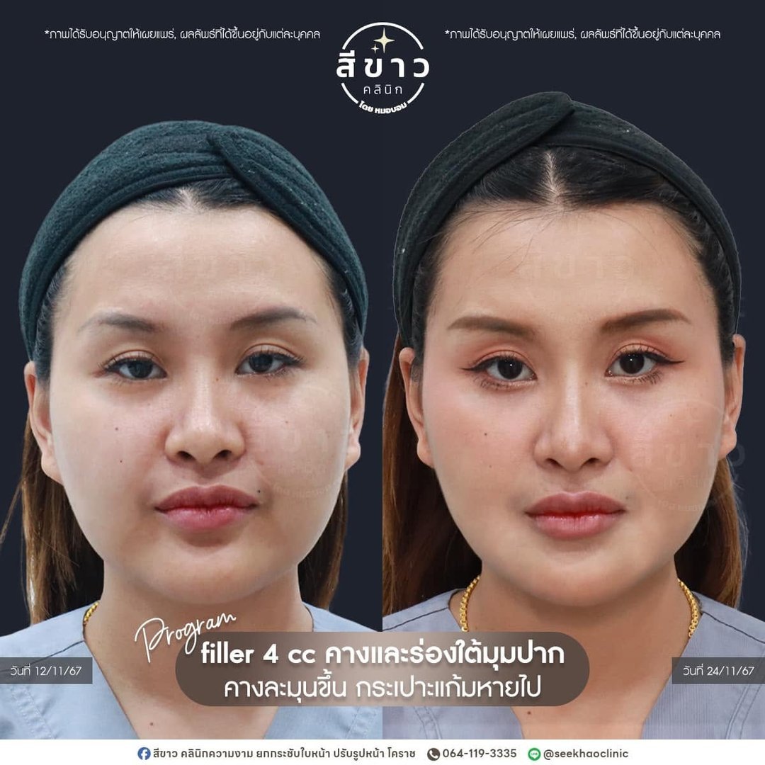 Filler 4 cc คางและร่องใต้มุมปาก
