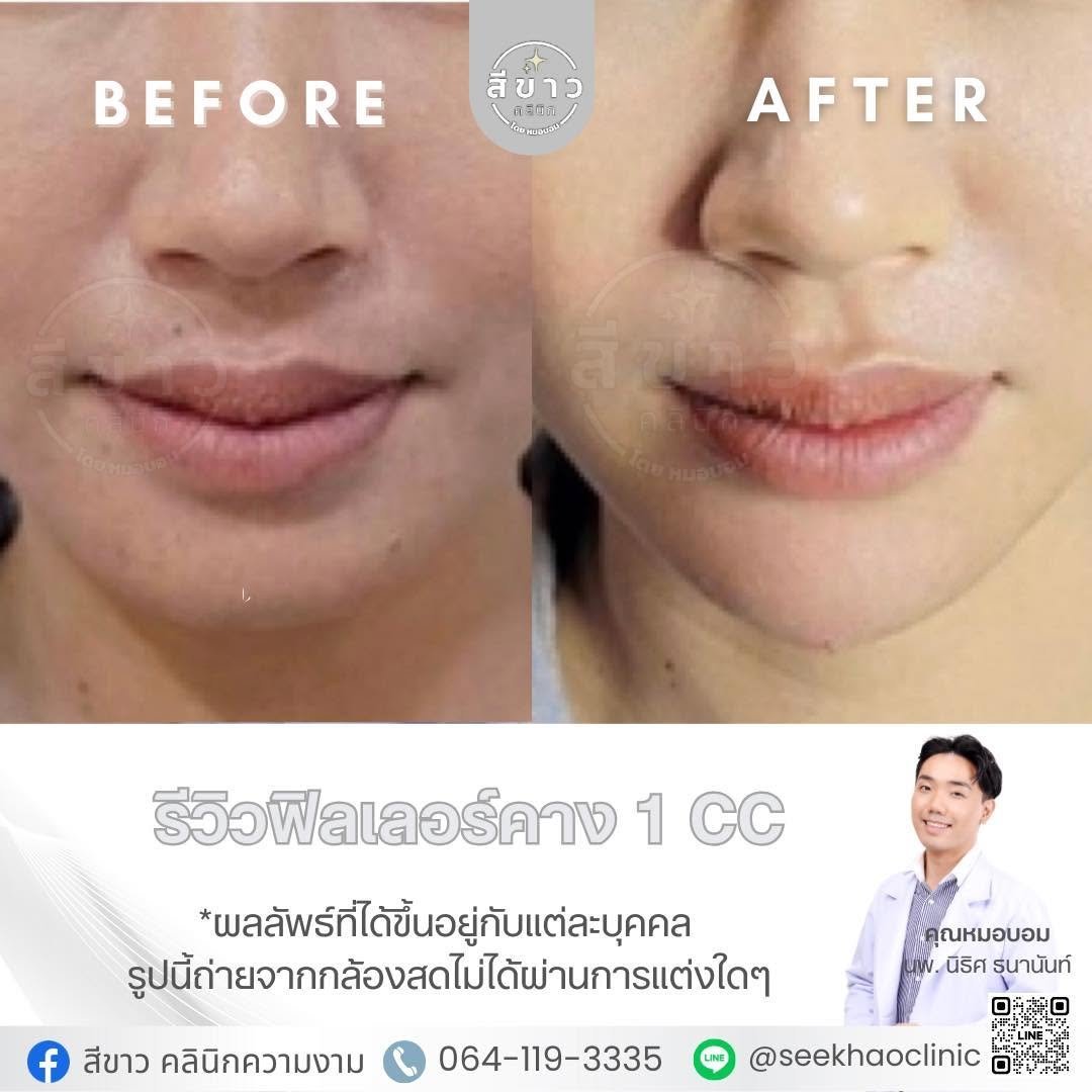 รีวิวฟิลเลอร์คาง 1 CC