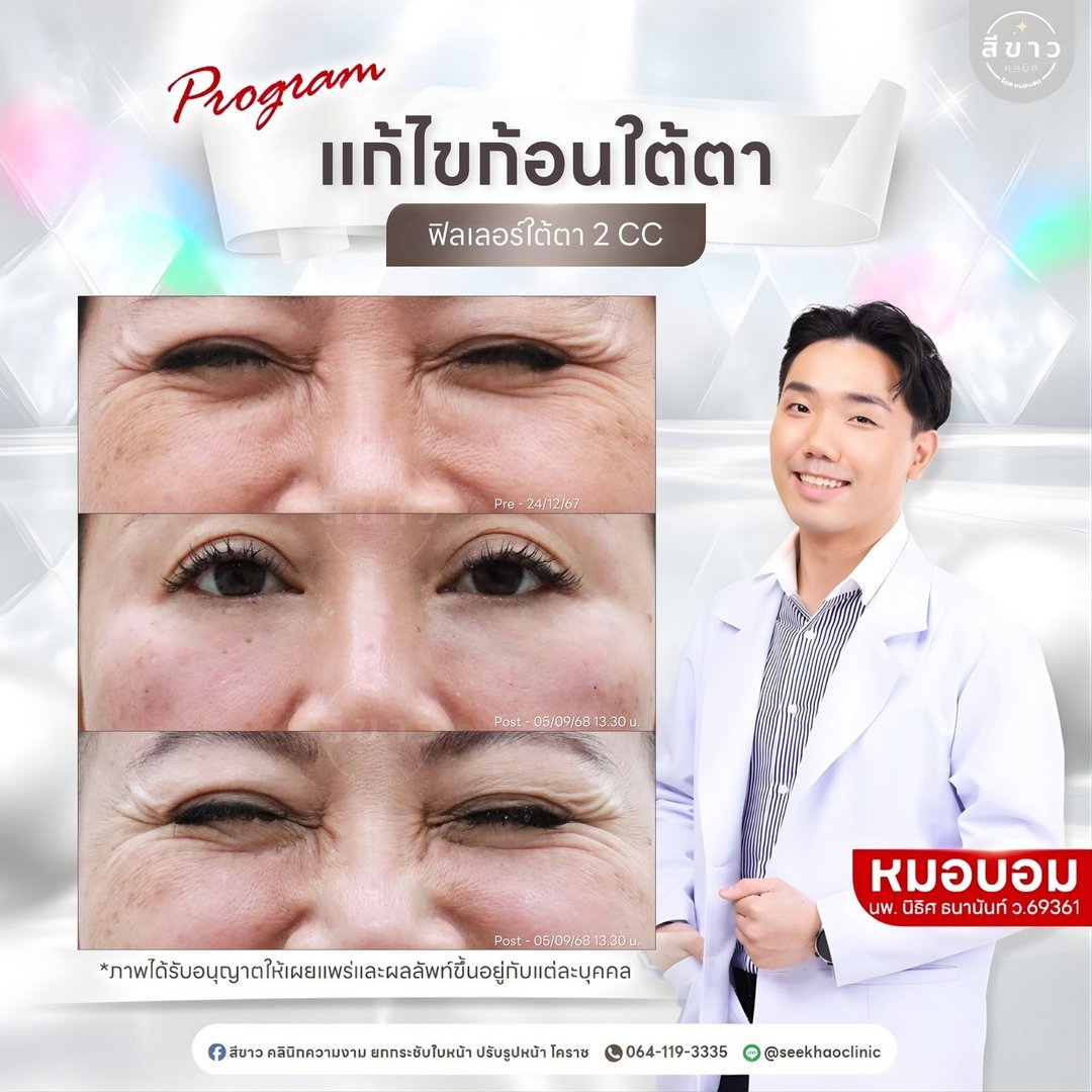 แก้ไขก้อนใต้ตา ฟิลเลอร์ใต้ตา 2 CC