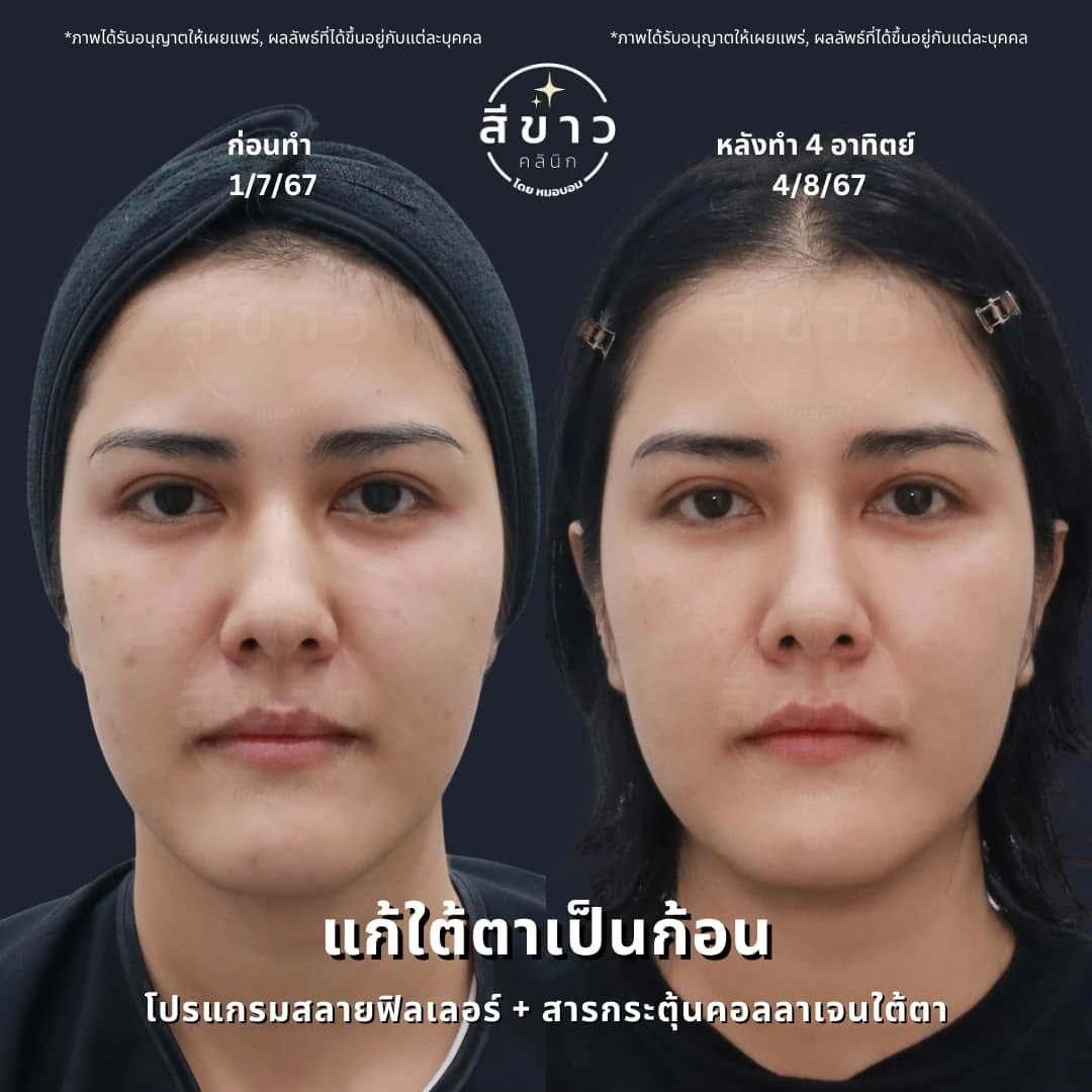 แก้ใต้ตาเป็นก้อน สลายฟิลเลอร์ + สารกระตุ้นคอลลาเจนใต้ตา