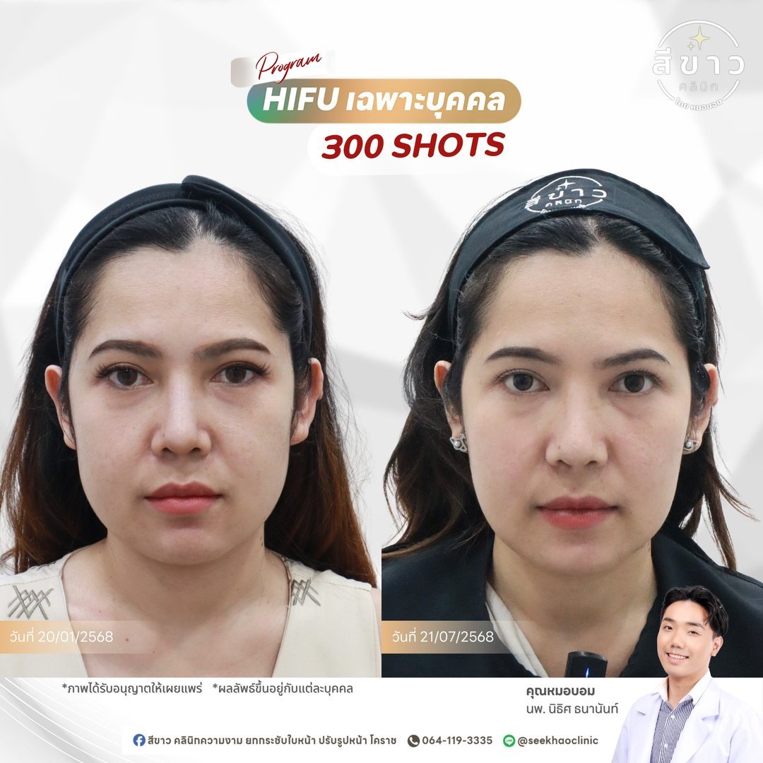 HIFU เฉพาะบุคคล 300 SHOTS