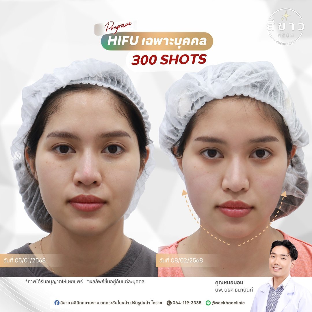 HIFU เฉพาะบุคคล 300 SHOTS