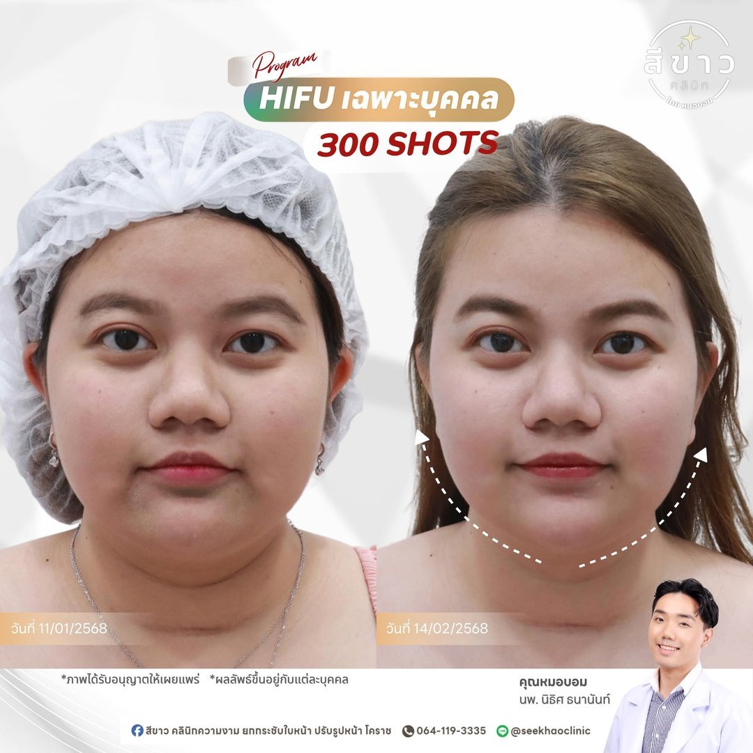 HIFU เฉพาะบุคคล 300 SHOTS