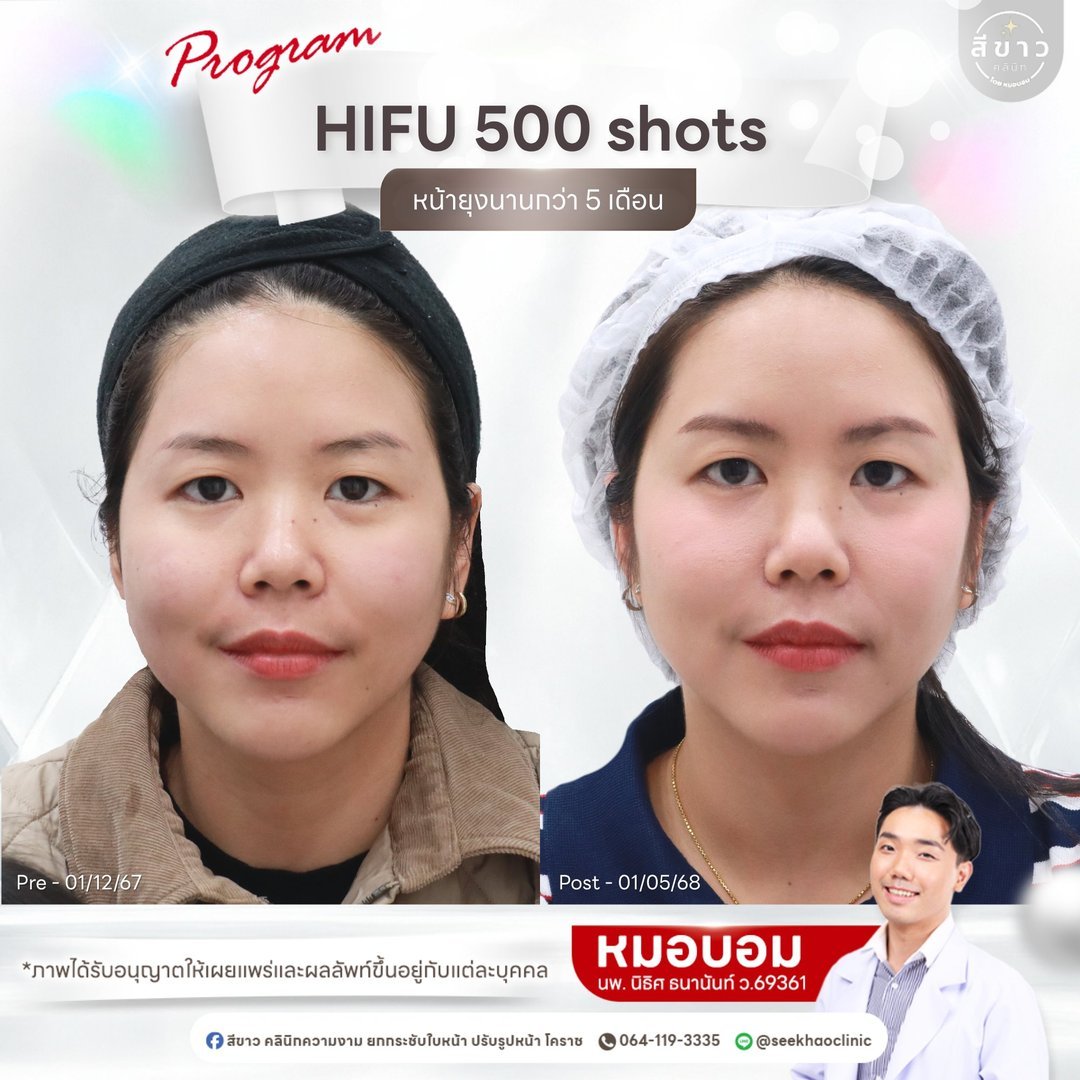 HIFU 500 shots หน้ายุบนานกว่า 5 เดือน