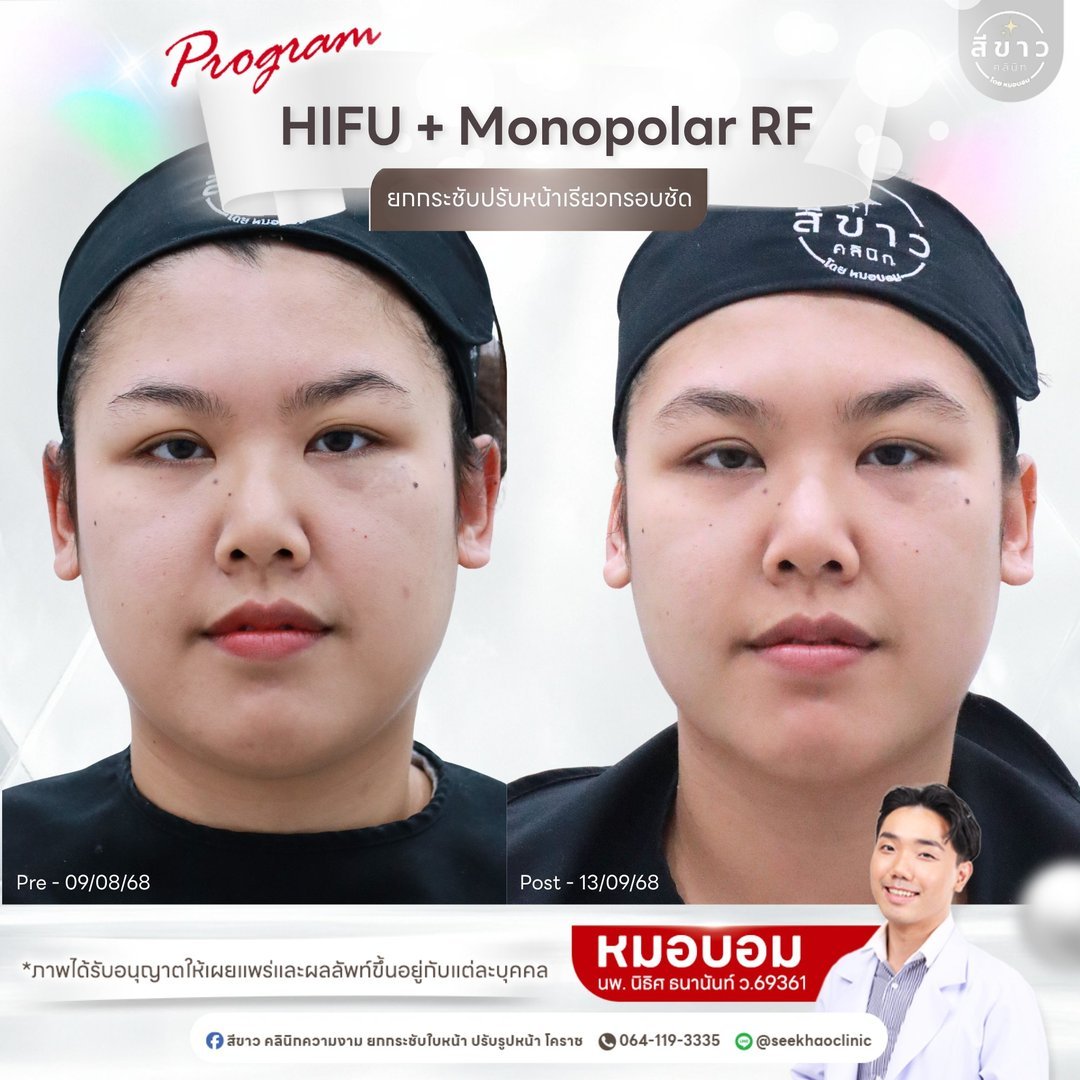 HIFU + Monopolar RF ยกกระชับปรับหน้าเรียวกรอบชัด