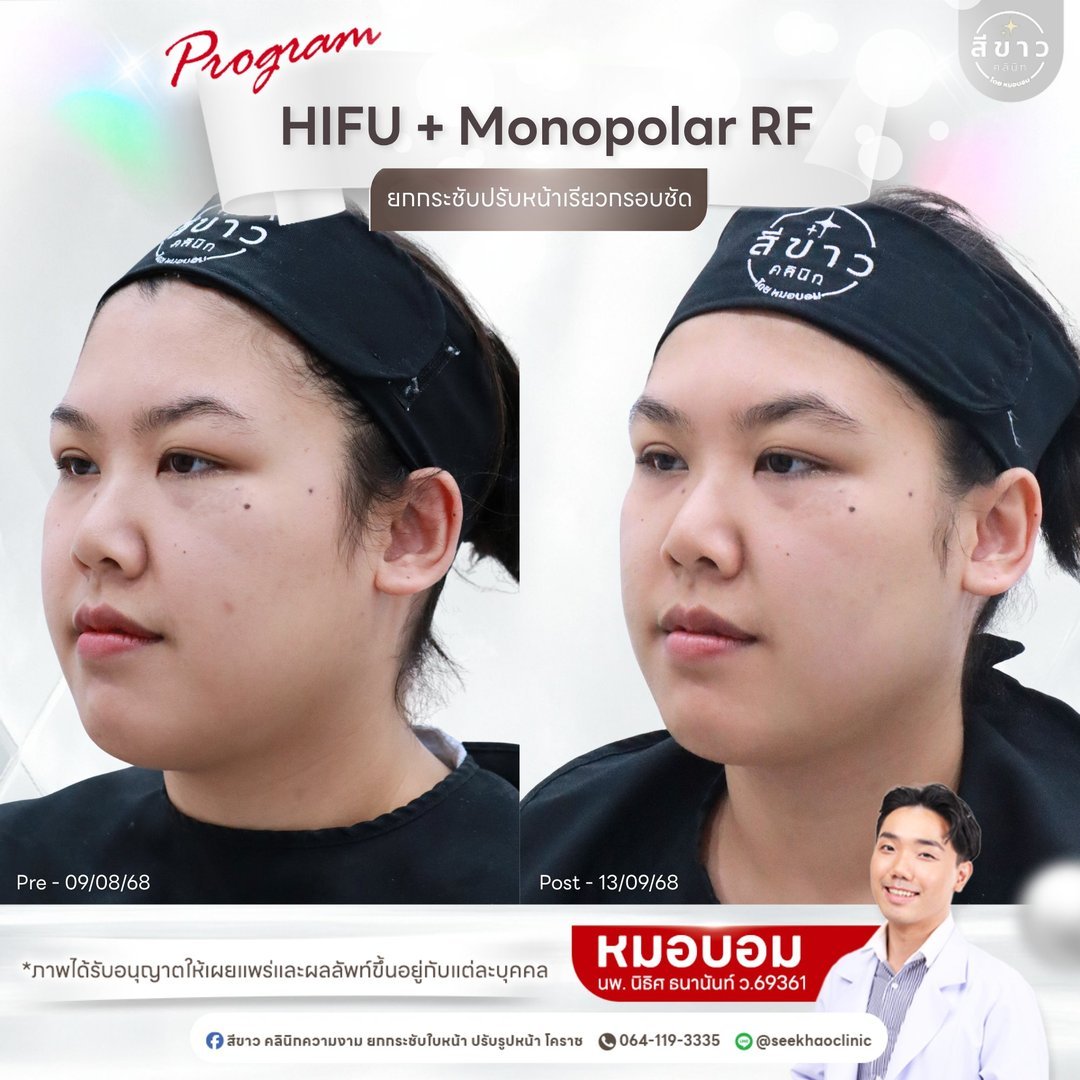 HIFU + Monopolar RF ยกกระชับปรับหน้าเรียวกรอบชัด