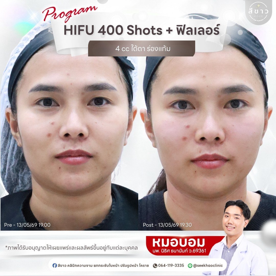 HIFU 400 Shots + ฟิลเลอร์ 4 cc ใต้ตา ร่องแก้ม
