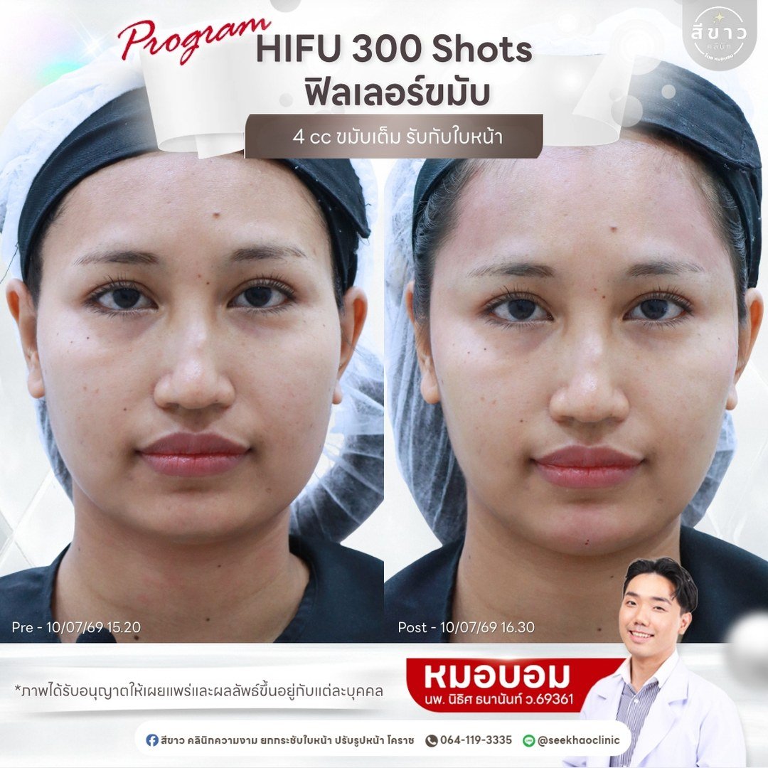 HIFU 300 Shots + ฟิลเลอร์ขมับ 4 cc