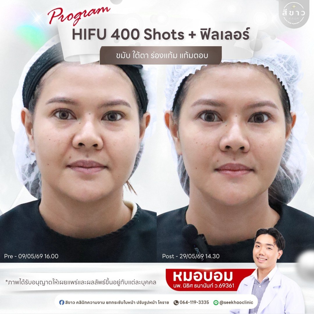 HIFU 400 Shots + ฟิลเลอร์ ขมับ ใต้ตา ร่องแก้ม แก้มตอบ