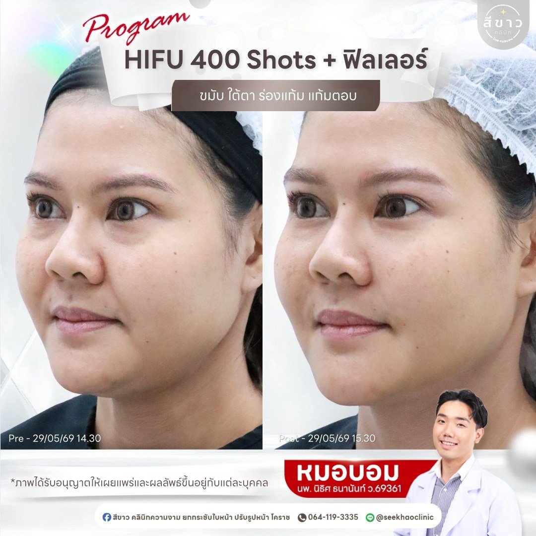 HIFU 400 Shots + ฟิลเลอร์ ขมับ ใต้ตา ร่องแก้ม แก้มตอบ