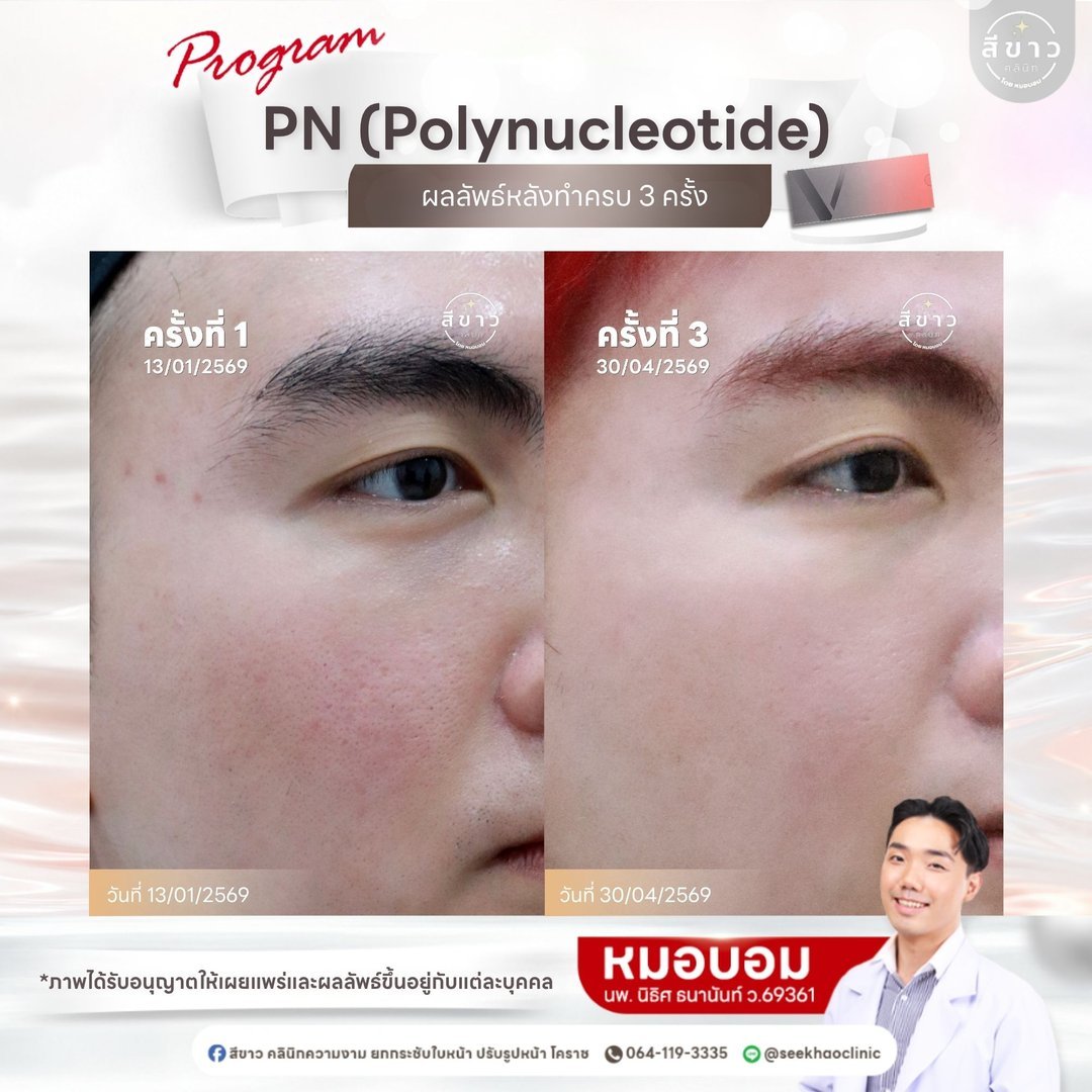 PN Polynucleotide ผลลัพธ์หลังทำครบ 3 ครั้ง เคส 1