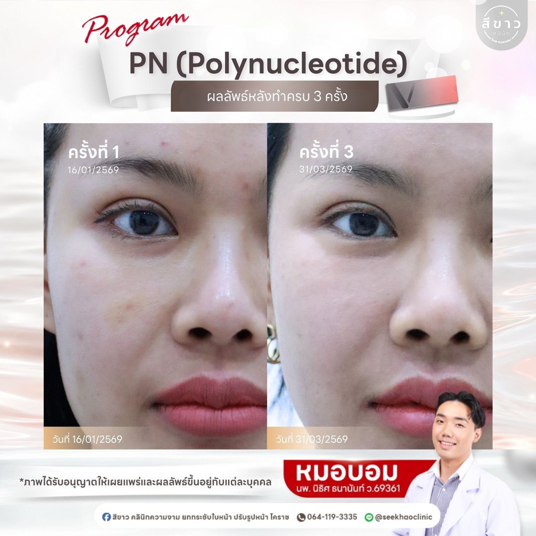 PN Polynucleotide ผลลัพธ์หลังทำครบ 3 ครั้ง เคส 2