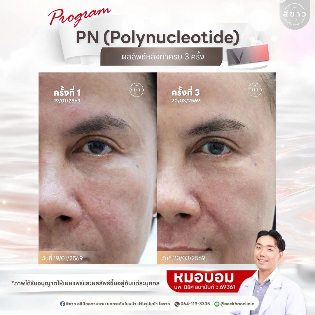 PN Polynucleotide ผลลัพธ์หลังทำครบ 3 ครั้ง เคส 3