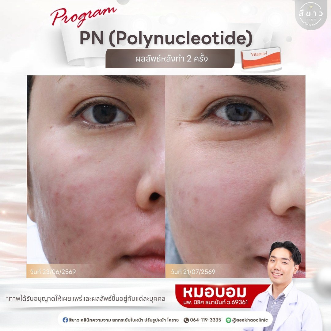 PN (Polynucleotide) ผลลัพธ์หลังทำ 2 ครั้ง